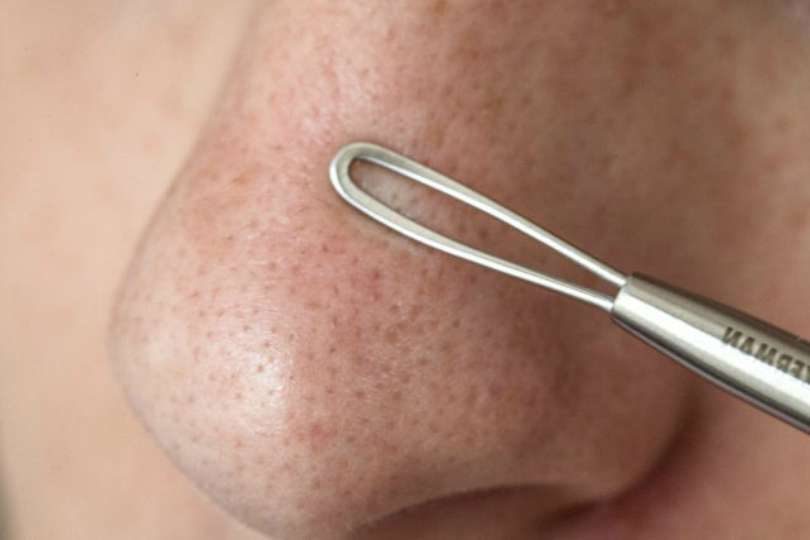 O Que Sao Cravos Tipos Causas E Como Tirar Do Nariz E Do Rosto Badalo