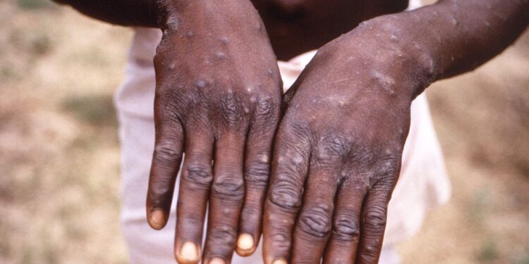 Privado: Varíola dos macacos: OMS anuncia resposta unificada contra doença