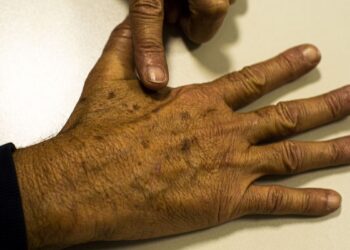 Dezembro Laranja; sociedade médica lança campanha de prevenção do câncer de pele