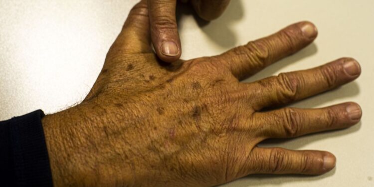 Dezembro Laranja; sociedade médica lança campanha de prevenção do câncer de pele