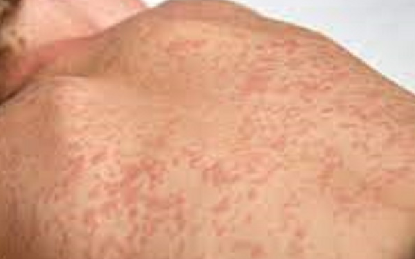 Crato participa de busca ativa e “Dia S” de combate ao sarampo